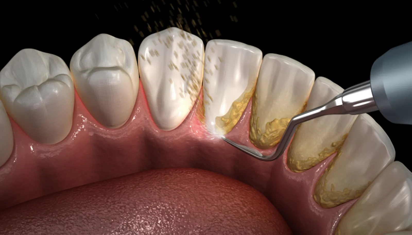 What is dental scaling and cleaning