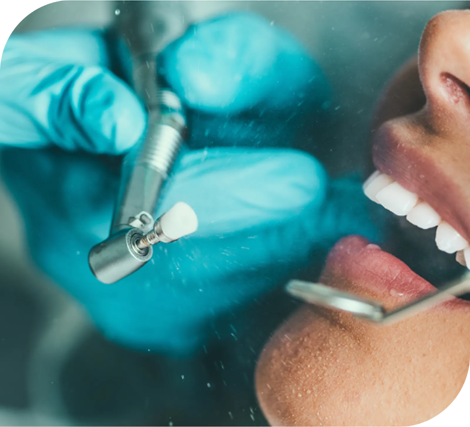 Professional teeth scaling and cleaning