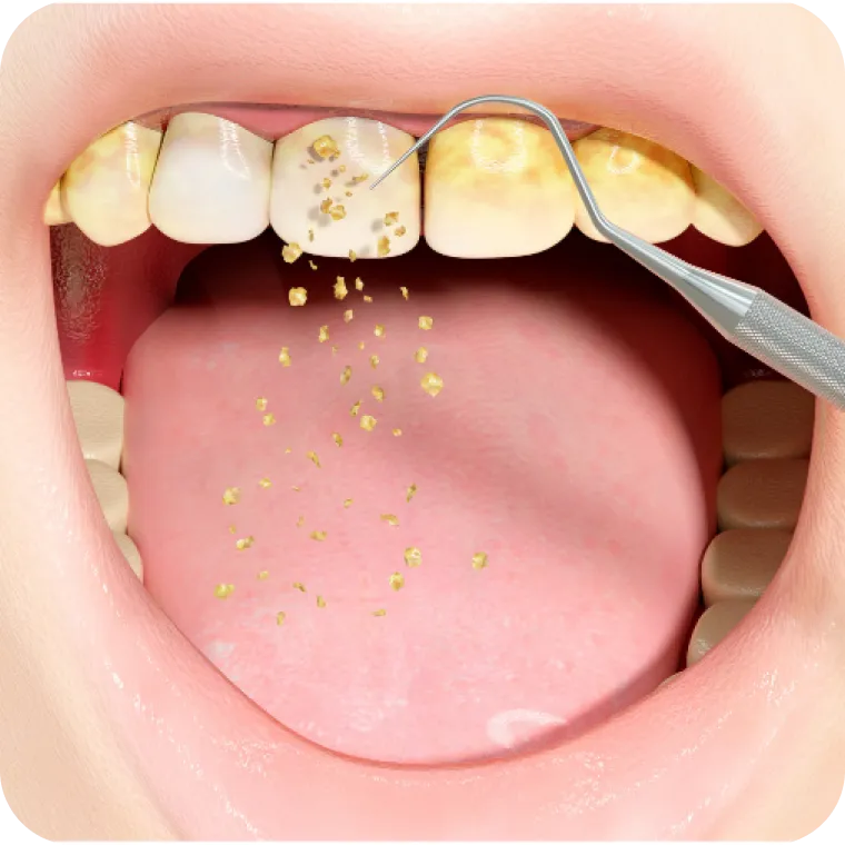 Teeth cleaning close-up
