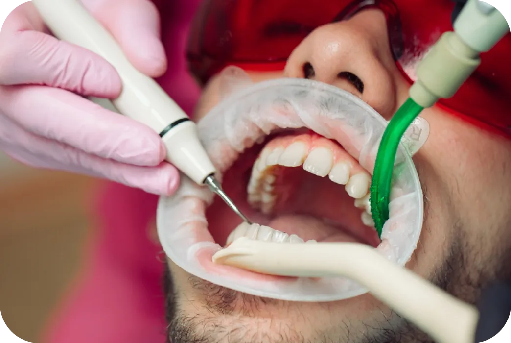 Healthy gums after cleaning