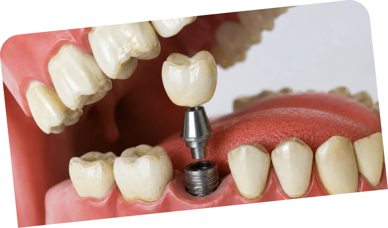 Healing & osseointegration