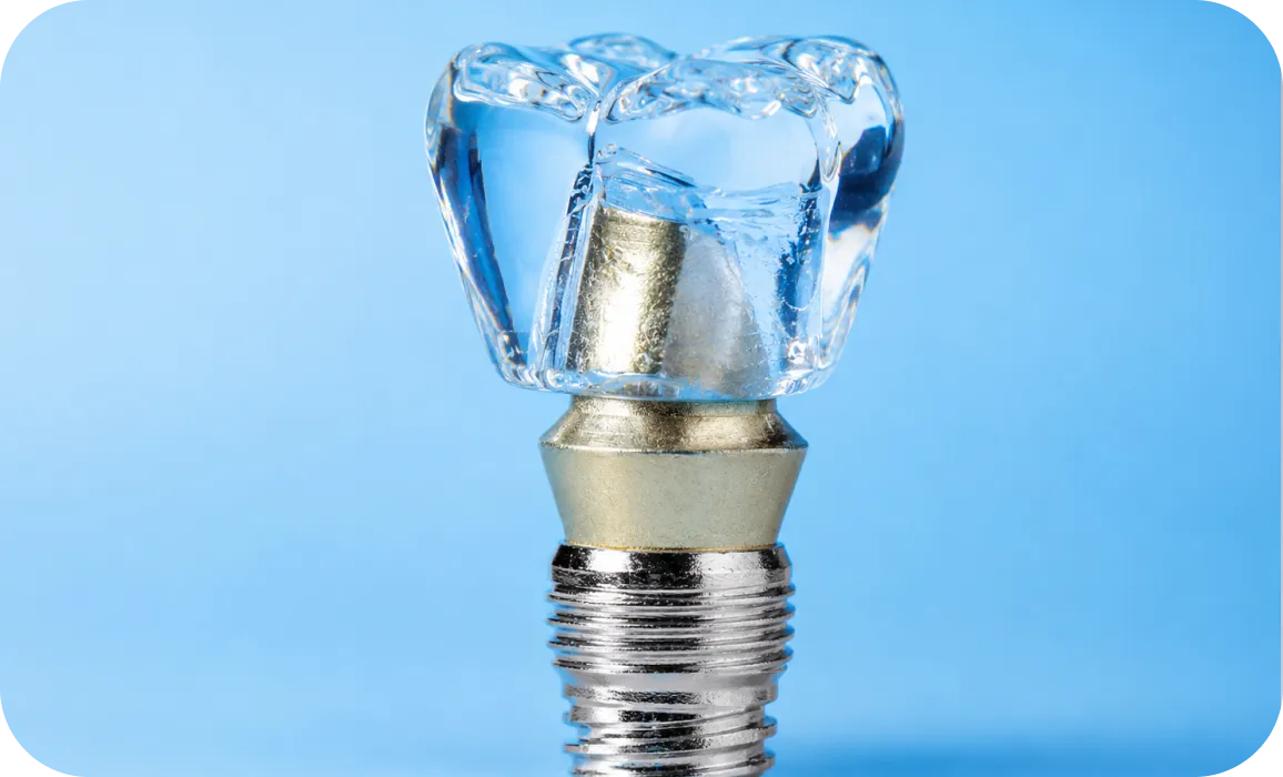 Implant specialist consultation