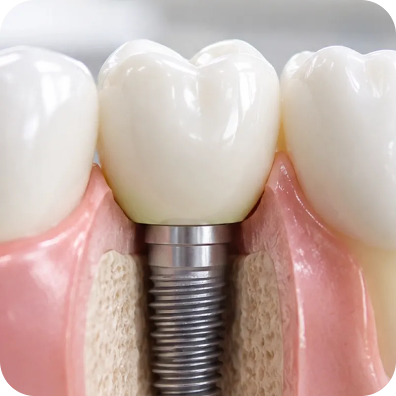 Smile makeover aligners