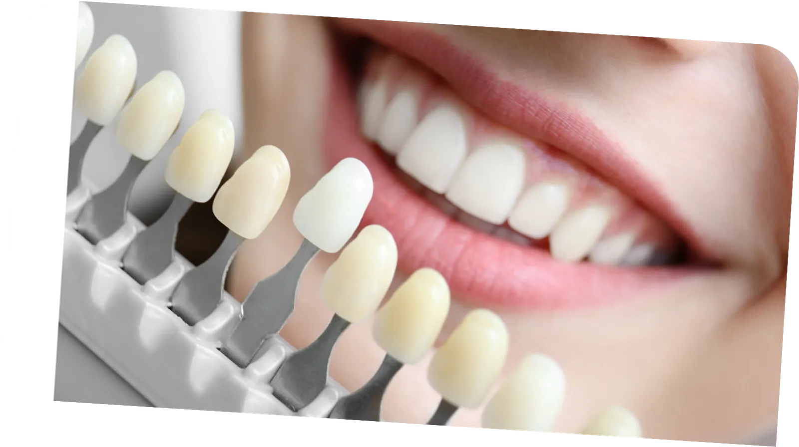 Consultation & tooth shade assessment