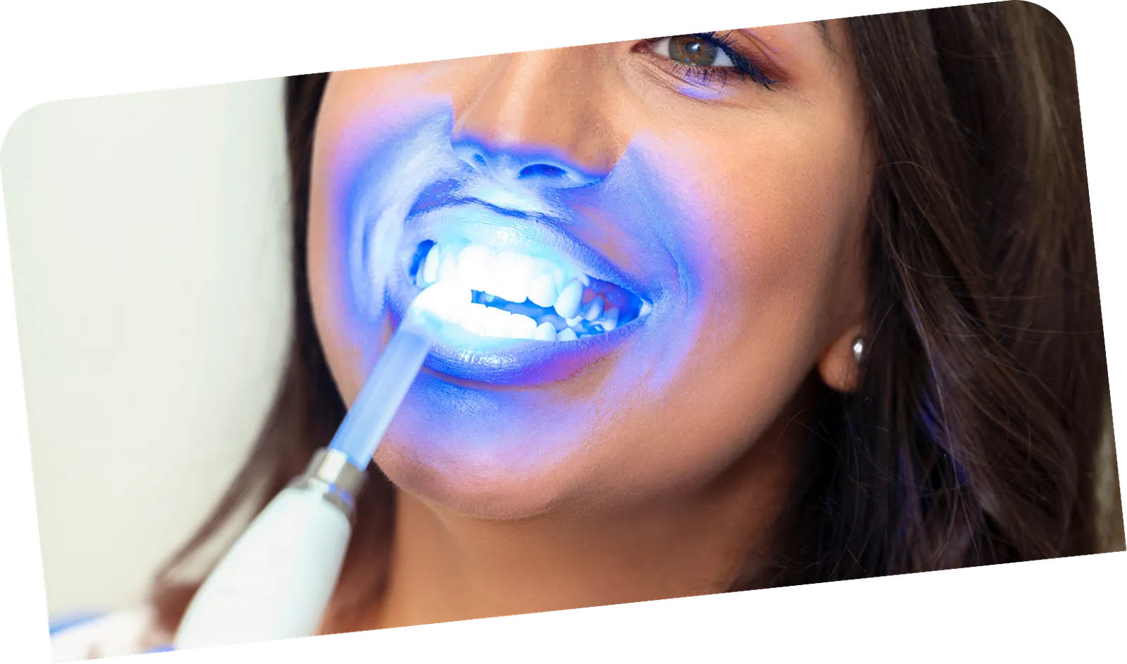 Teeth whitening