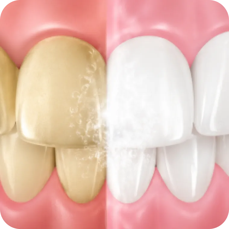 Teeth whitening close-up