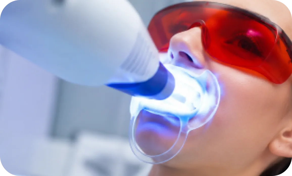 Smile makeover clean white teeth