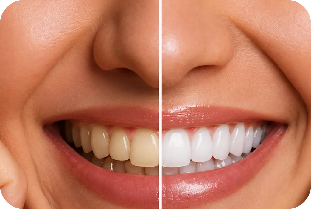 Bright smile after whitening