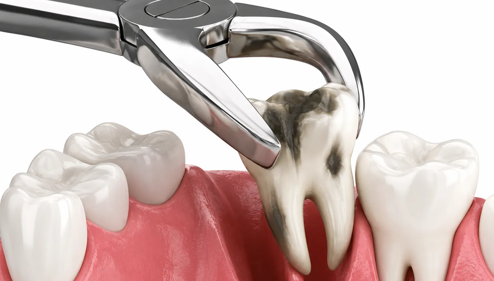 What is a tooth extraction