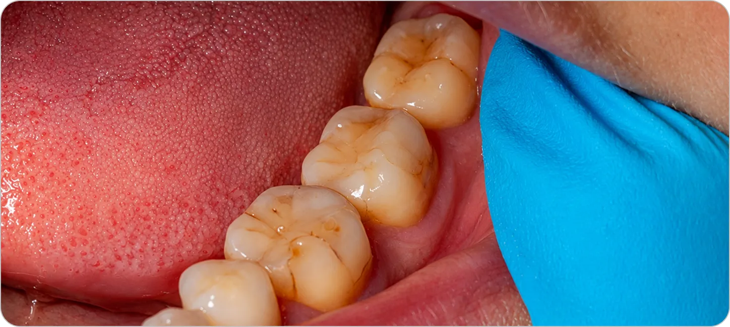 Stops infection from spreading