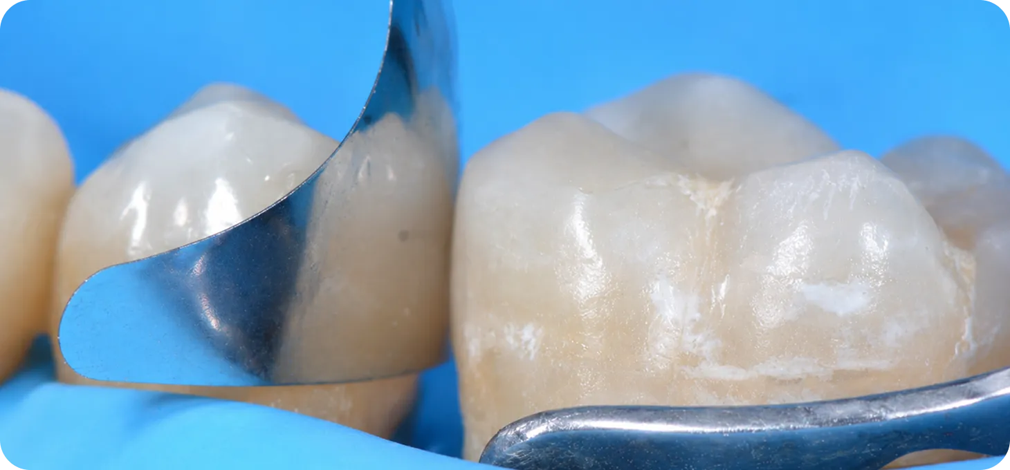 Protects adjacent teeth