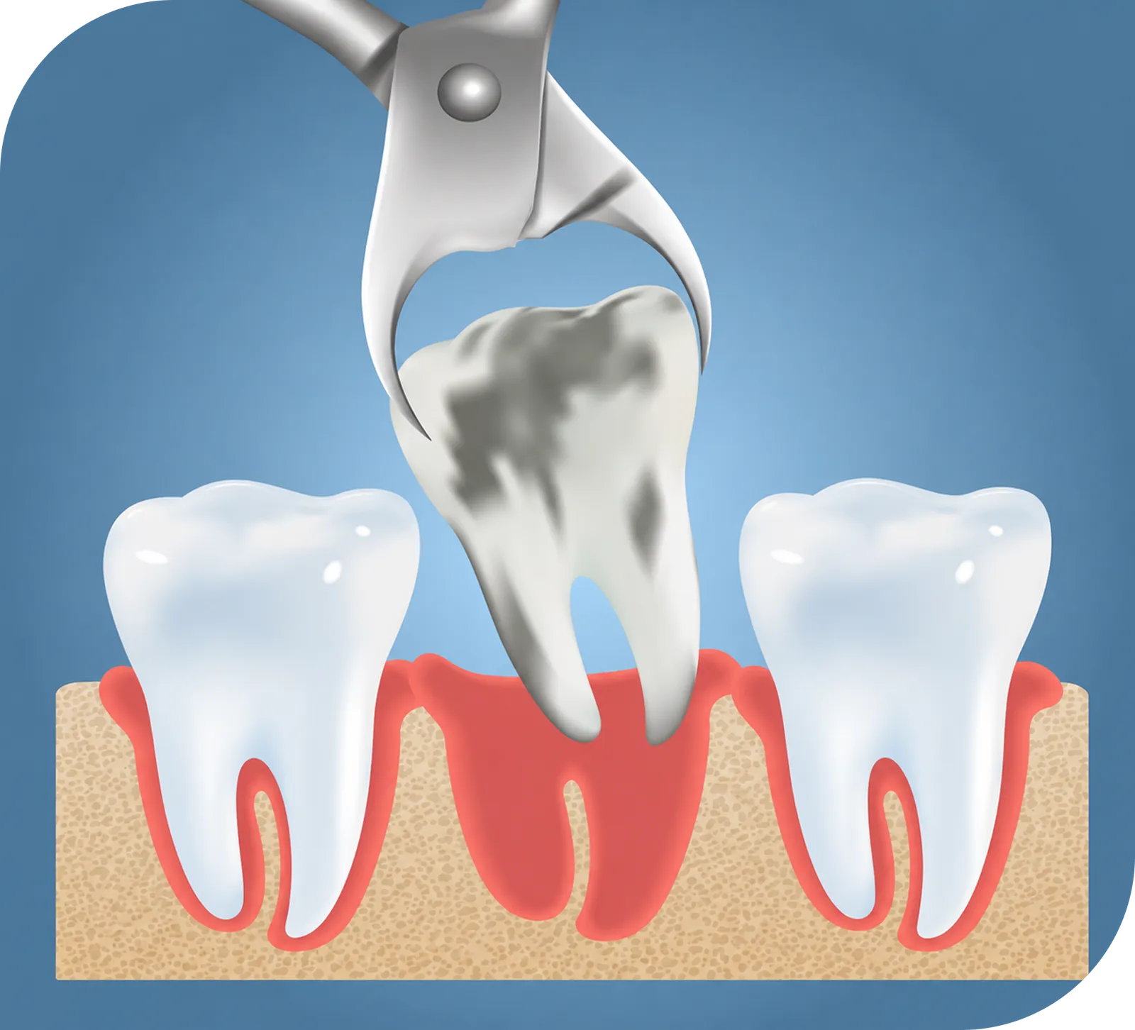 Gentle tooth extraction at AVMSmiles