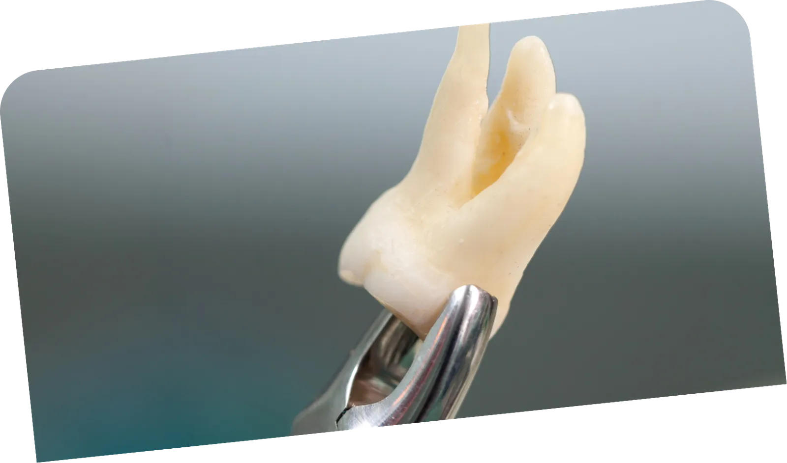Tooth removal